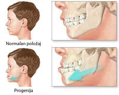 malocluzije prognatism